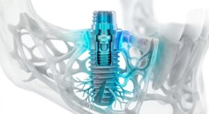 디지털 임플란트 3D 구조 일러스트
